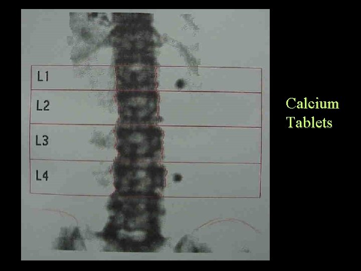 Calcium Tablets 