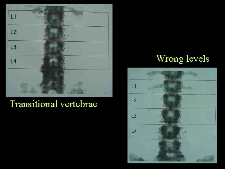 Wrong levels Transitional vertebrae 