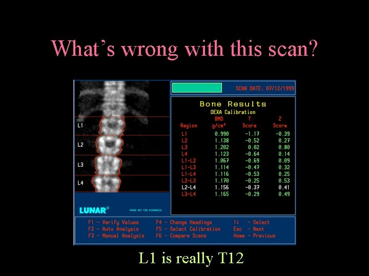 What’s wrong with this scan? L 1 is really T 12 