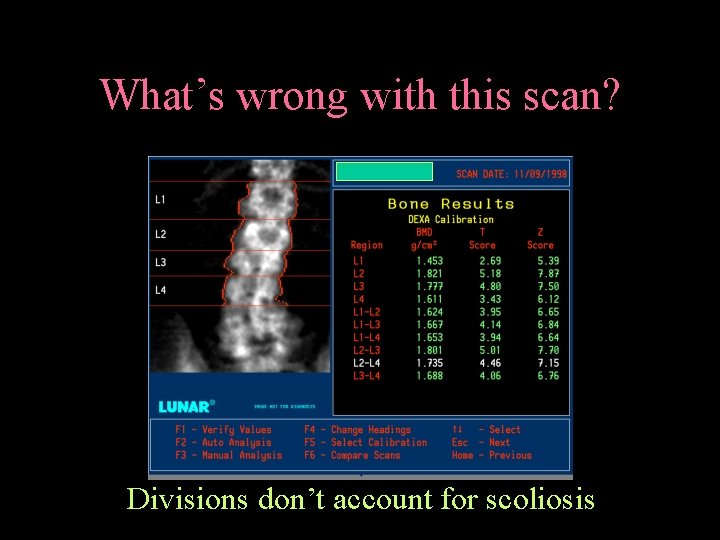 What’s wrong with this scan? Divisions don’t account for scoliosis 