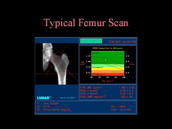 Typical Femur Scan 