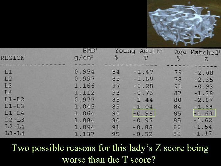 Two possible reasons for this lady’s Z score being worse than the T score?