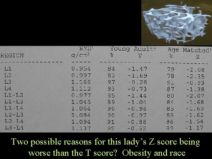 Two possible reasons for this lady’s Z score being worse than the T score?