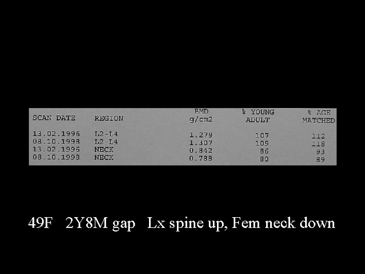 49 F 2 Y 8 M gap Lx spine up, Fem neck down 