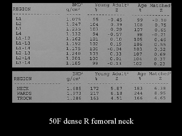 50 F dense R femoral neck 