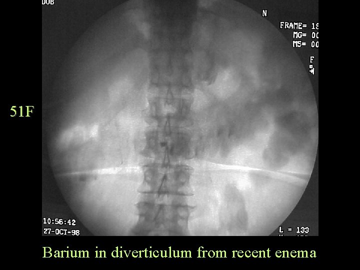 51 F Barium in diverticulum from recent enema 