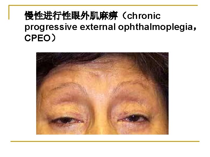 慢性进行性眼外肌麻痹（chronic progressive external ophthalmoplegia， CPEO） 