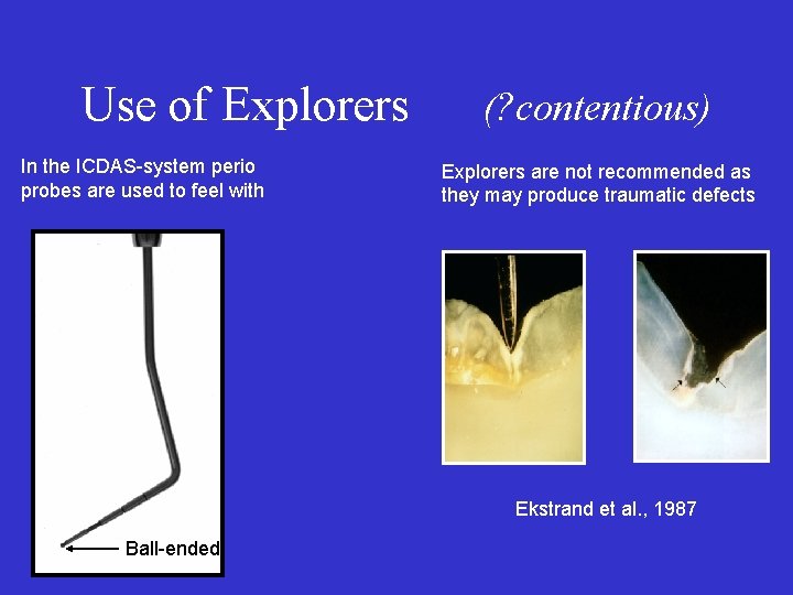Use of Explorers In the ICDAS-system perio probes are used to feel with (?
