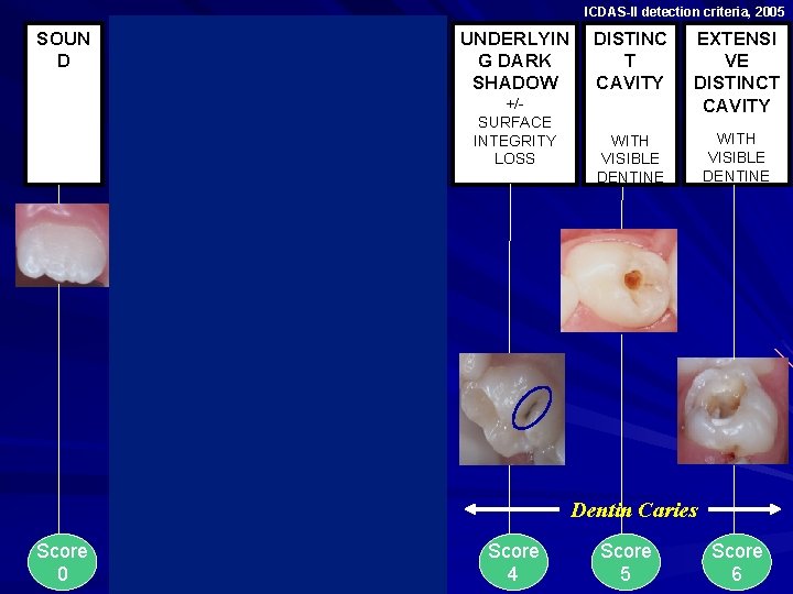 ICDAS-II detection criteria, 2005 SOUN D OPACIT Y First Visible Change Distinct Visible Change