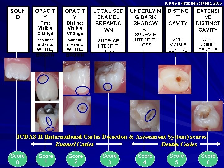 ICDAS-II detection criteria, 2005 SOUN D OPACIT Y First Visible Change Distinct Visible Change