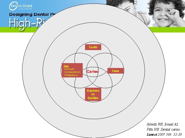 Tooth Diet • Amount • Composition • Frequency Caries Time Bacteria In Biofilm Selwitz