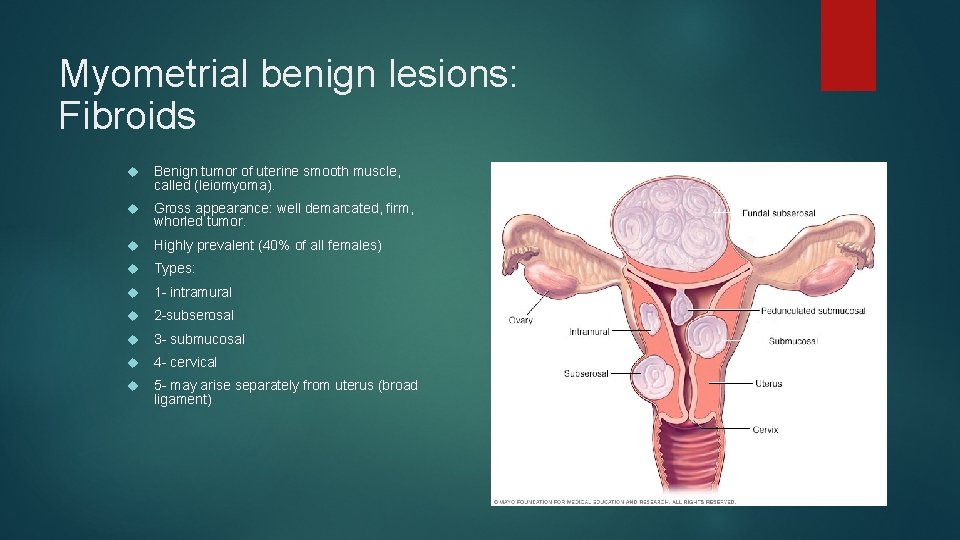 Myometrial benign lesions: Fibroids Benign tumor of uterine smooth muscle, called (leiomyoma). Gross appearance: