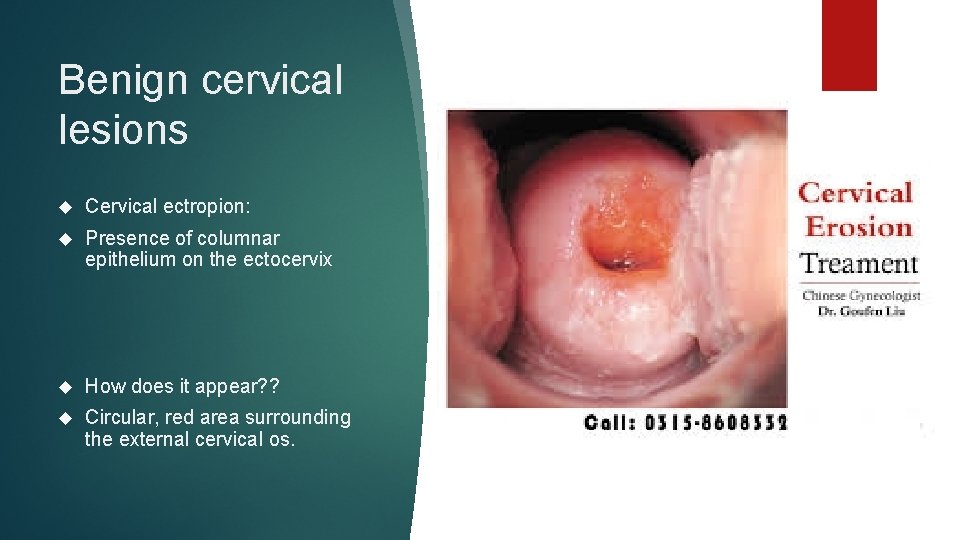 Benign cervical lesions Cervical ectropion: Presence of columnar epithelium on the ectocervix How does