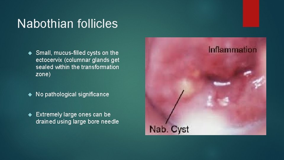Nabothian follicles Small, mucus-filled cysts on the ectocervix (columnar glands get sealed within the