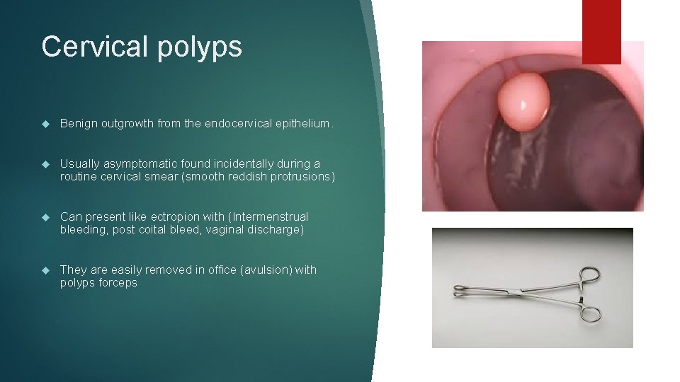 Cervical polyps Benign outgrowth from the endocervical epithelium. Usually asymptomatic found incidentally during a