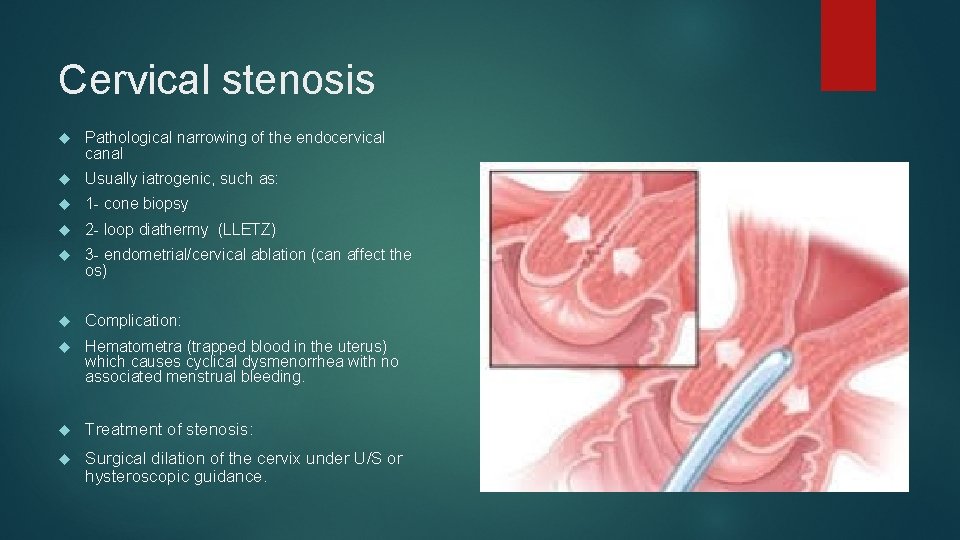 Cervical stenosis Pathological narrowing of the endocervical canal Usually iatrogenic, such as: 1 -