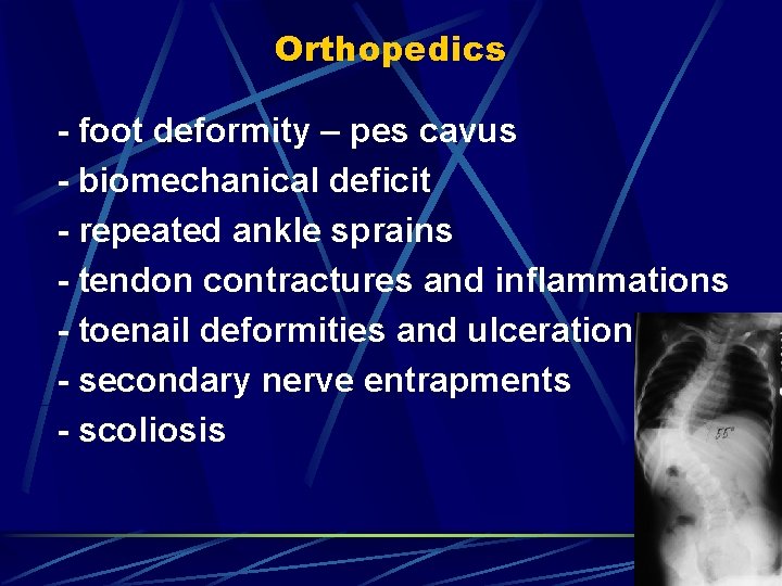 Orthopedics - foot deformity – pes cavus - biomechanical deficit - repeated ankle sprains