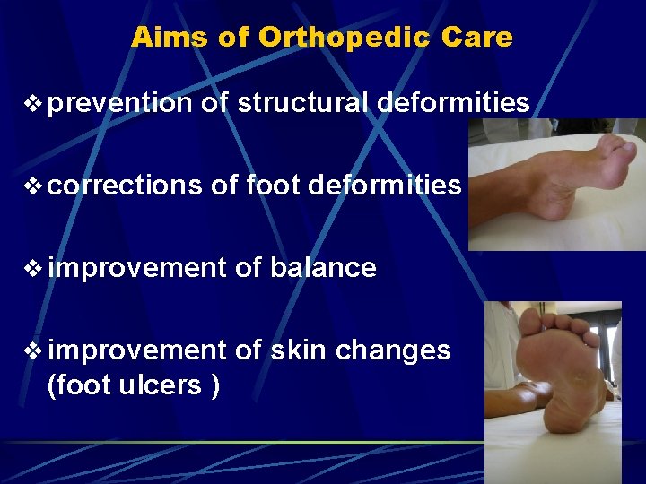 Aims of Orthopedic Care v prevention of structural deformities v corrections of foot deformities