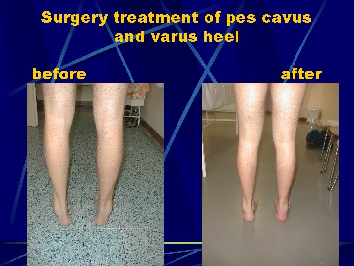 Surgery treatment of pes cavus and varus heel before after 