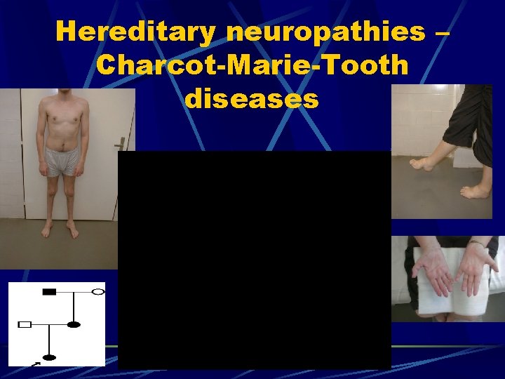 Hereditary neuropathies – Charcot-Marie-Tooth diseases 