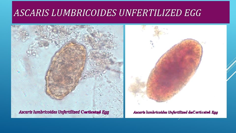 ASCARIS LUMBRICOIDES UNFERTILIZED EGG Ascaris lumbricoides Unfertilized Corticated Egg Ascaris lumbricoides Unfertilized de. Corticated