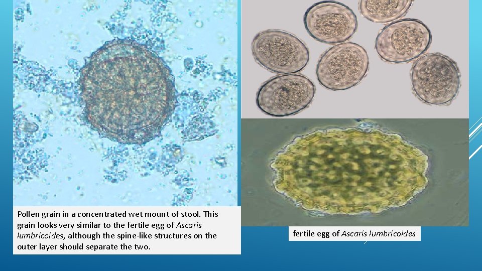 Pollen grain in a concentrated wet mount of stool. This grain looks very similar