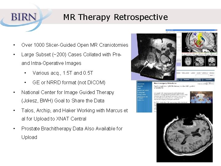 MR Therapy Retrospective • Over 1000 Slicer-Guided Open MR Craniotomies • Large Subset (~200)