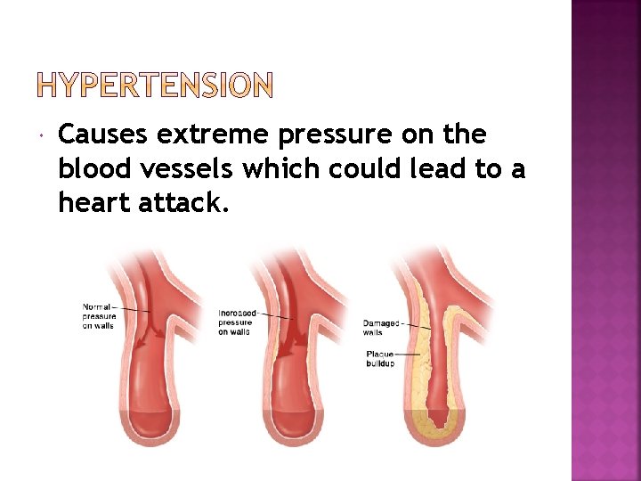  Causes extreme pressure on the blood vessels which could lead to a heart