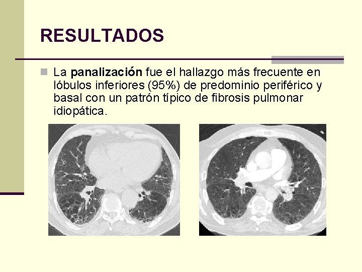 RESULTADOS n La panalización fue el hallazgo más frecuente en lóbulos inferiores (95%) de