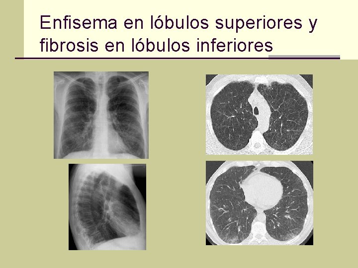 Enfisema en lóbulos superiores y fibrosis en lóbulos inferiores 