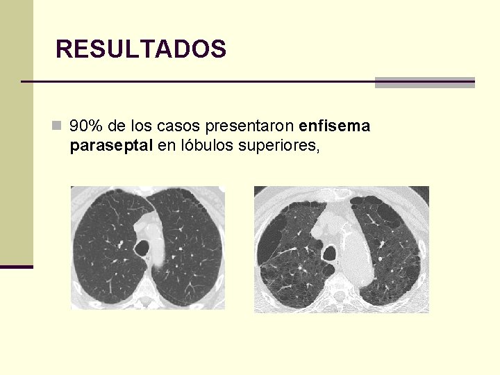 RESULTADOS n 90% de los casos presentaron enfisema paraseptal en lóbulos superiores, 