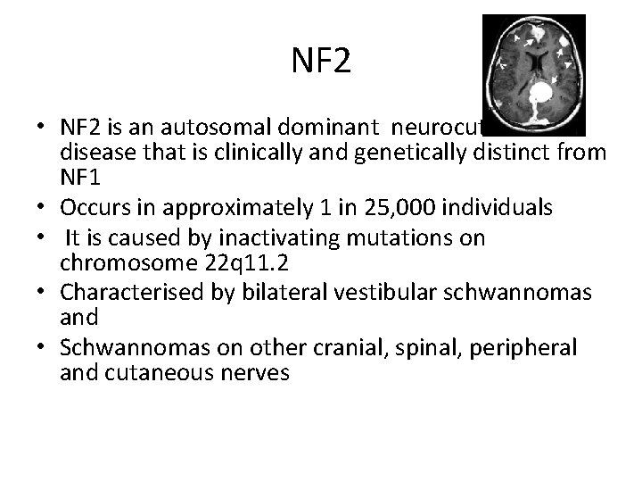 NF 2 • NF 2 is an autosomal dominant neurocutaneous disease that is clinically