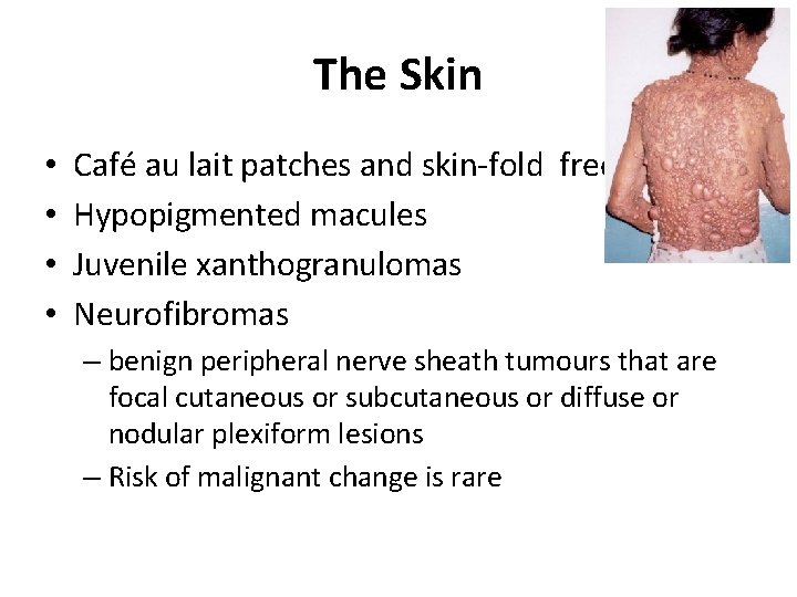 The Skin • • Café au lait patches and skin-fold freckling Hypopigmented macules Juvenile