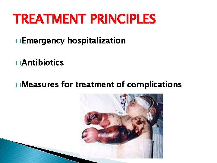 TREATMENT PRINCIPLES � Emergency hospitalization � Antibiotics � Measures for treatment of complications 