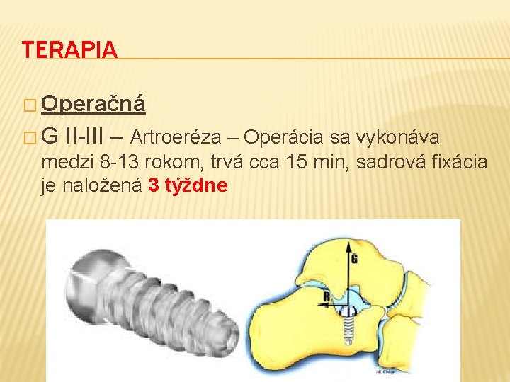 TERAPIA � Operačná �G II-III – Artroeréza – Operácia sa vykonáva medzi 8 -13