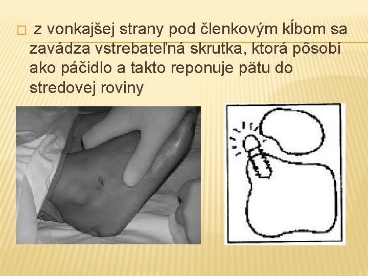 � z vonkajšej strany pod členkovým kĺbom sa zavádza vstrebateľná skrutka, ktorá pôsobí ako