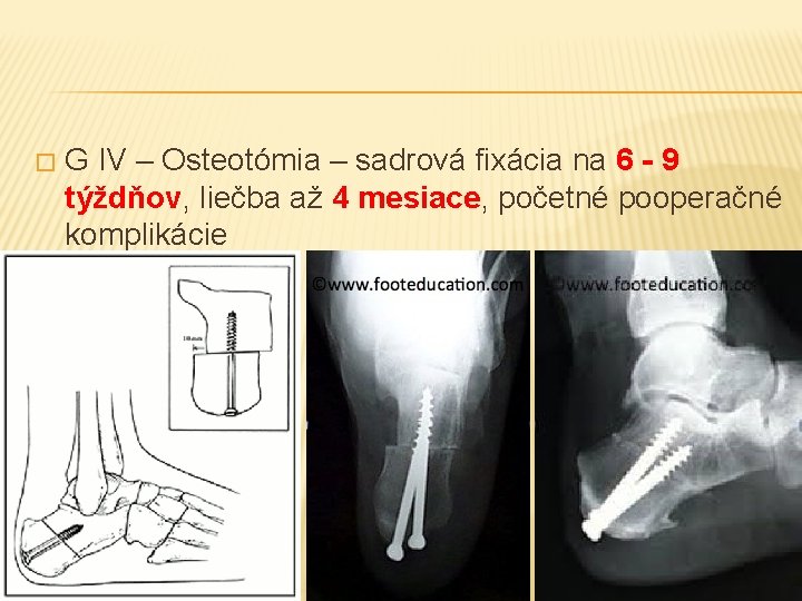 � G IV – Osteotómia – sadrová fixácia na 6 - 9 týždňov, liečba