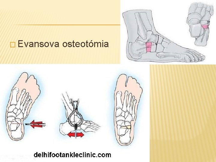 � Evansova osteotómia 