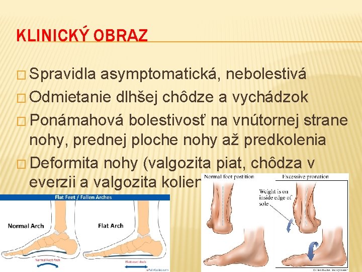 KLINICKÝ OBRAZ � Spravidla asymptomatická, nebolestivá � Odmietanie dlhšej chôdze a vychádzok � Ponámahová