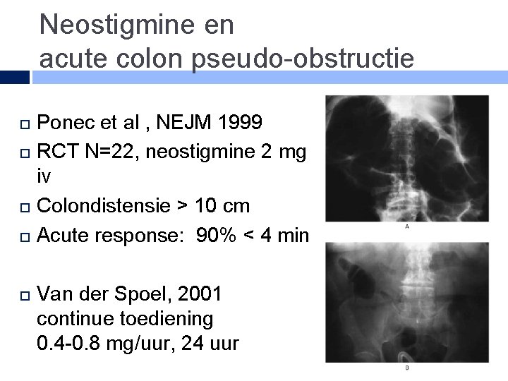 Neostigmine en acute colon pseudo-obstructie Ponec et al , NEJM 1999 RCT N=22, neostigmine