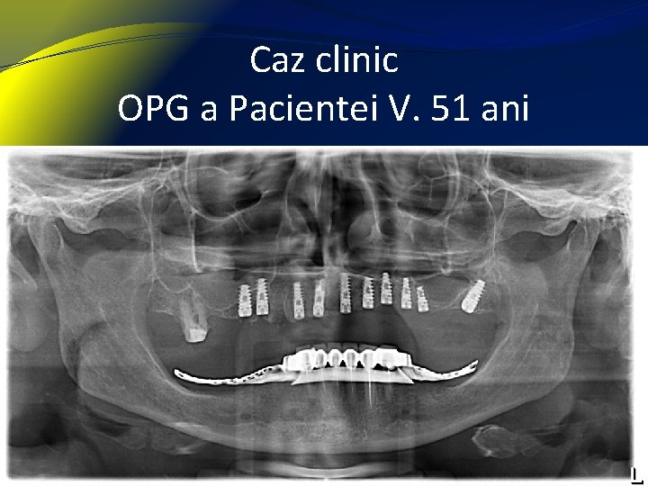 Caz clinic OPG a Pacientei V. 51 ani 27 februarie 2021 13 