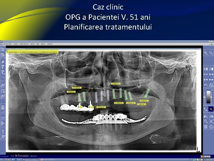 Caz clinic OPG a Pacientei V. 51 ani Planificarea tratamentului 27 februarie 2021 14