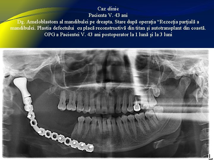 Caz clinic Pacienta V. 43 ani Dg. Ameloblastom al mandibulei pe dreapta. Stare după