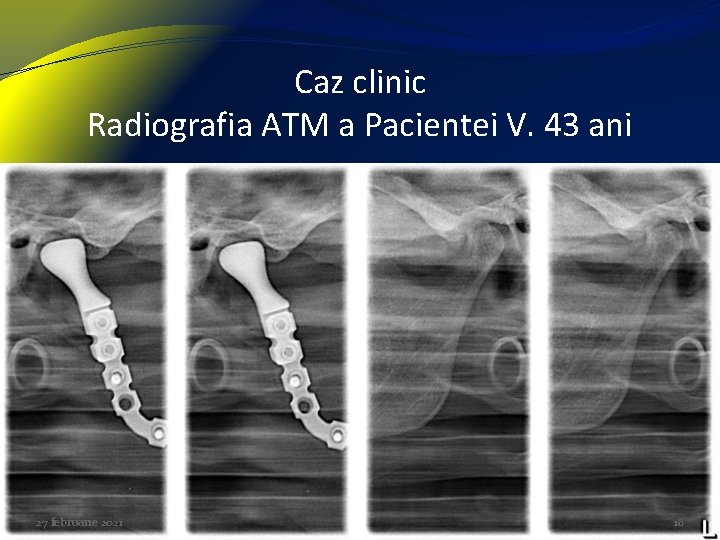 Caz clinic Radiografia ATM a Pacientei V. 43 ani 27 februarie 2021 16 