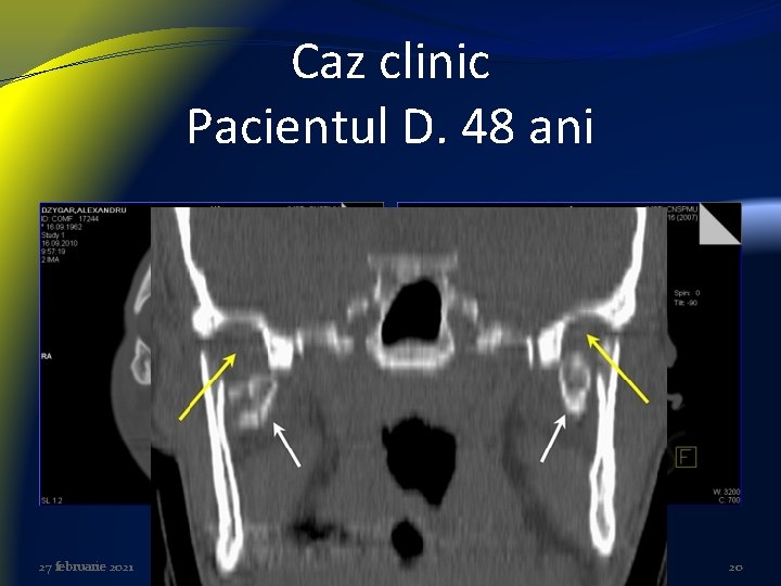 Caz clinic Pacientul D. 48 ani 27 februarie 2021 20 