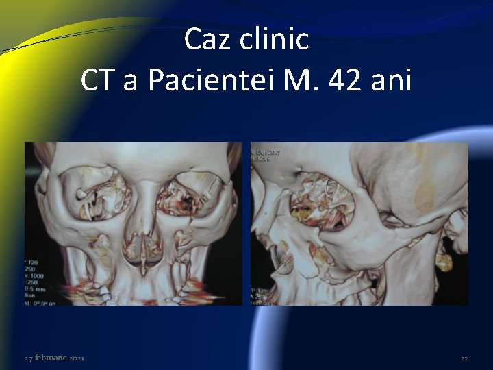 Caz clinic CT a Pacientei M. 42 ani 27 februarie 2021 22 