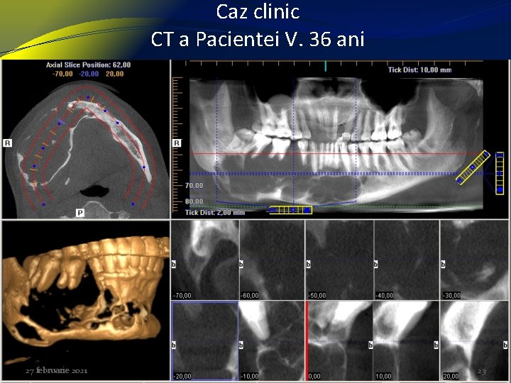Caz clinic CT a Pacientei V. 36 ani 27 februarie 2021 23 