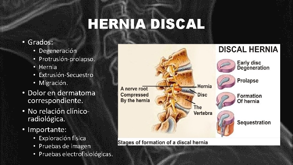 HERNIA DISCAL • Grados: • • • Degeneración Protrusión-prolapso. Hernia Extrusión-Secuestro Migración. • Dolor
