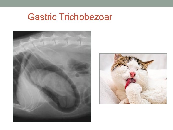 Gastric Trichobezoar 
