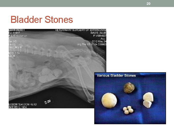 20 Bladder Stones 